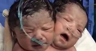 Рребенок с двумя головами родился в украинских Черновцах - врачи говорят о сиамских близнецах