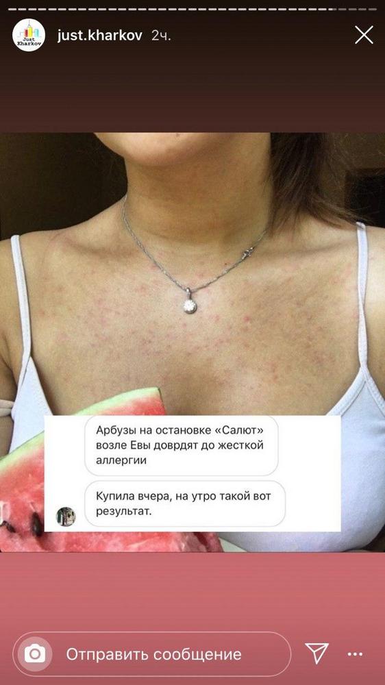 ФОТО: В Харькове девушка отравилась арбузом - после поедания лакомства появилась мощная аллергическая реакция