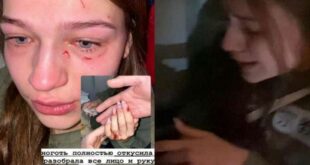 ФОТО: Расцарапали до крови лицо и откусили ноготь: в самолете в Доминикану жестоко избили украинку