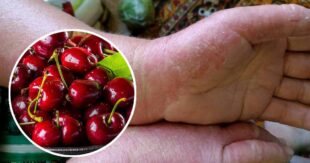 Красные руки, облезшая кожа: на сборе черешни в Мелитополе женщина заработала химический ожог от плодов