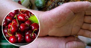 Красные руки, облезшая кожа: на сборе черешни в Мелитополе женщина заработала химический ожог от плодов
