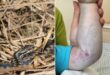В Ивано-Франковской области госпитализировали троих детей с укусами змей, они в тяжелом состоянии в реанимации