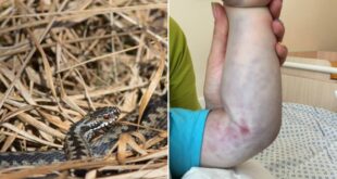 В Ивано-Франковской области госпитализировали троих детей с укусами змей, они в тяжелом состоянии в реанимации